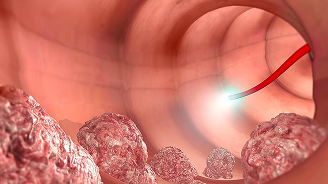 大腸内視鏡検査とは？