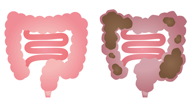 大腸の疾患