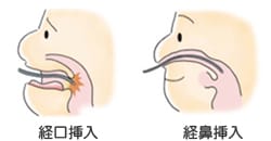 経口挿入 経鼻挿入