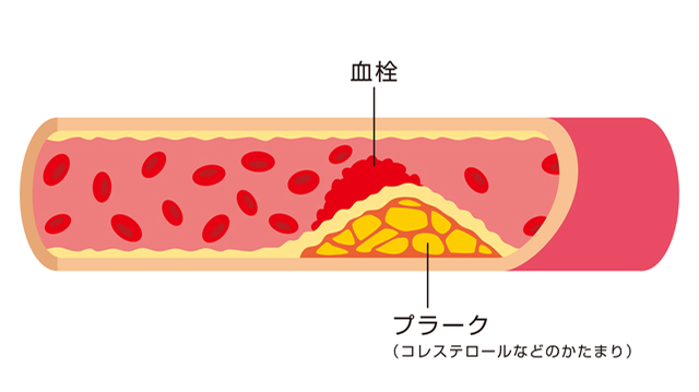 動脈硬化の評価（頸動脈エコー）